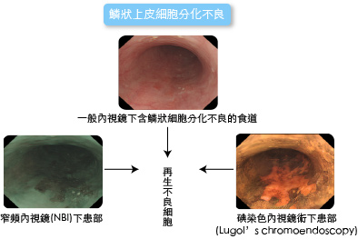 鱗狀上皮細胞分化不良